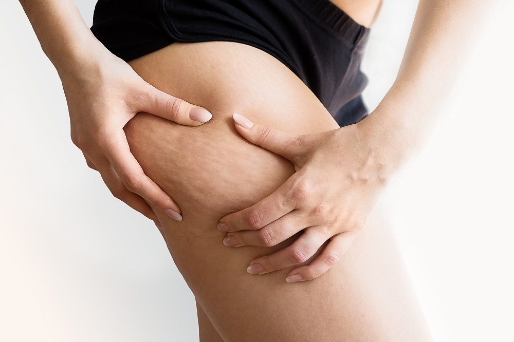 Anti Cellulite Massage - M-T-N